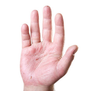 Patient with Allergic Contact Dermatitis on his palms