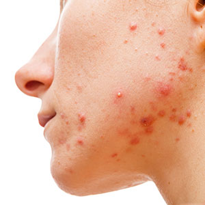 Acne and facial treatments in Phoenix