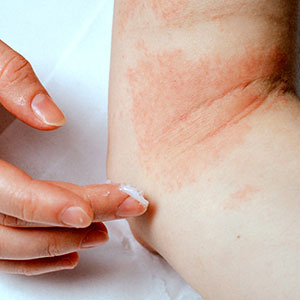 Eczema/Atopic Dermatitis