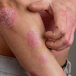 Man with psoriasis on hands and arms before being treated at Saguaro Dermatology - Phoenix Dermatologist