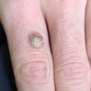 Closeup view of a wart on a patients finger prior to removal by a dermatologist at Phoenix's Saguaro Dermatology