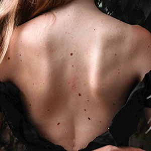 Woman's back before a mole removal procedure at Saguaro Dermatology - Phoenix Dermatologist