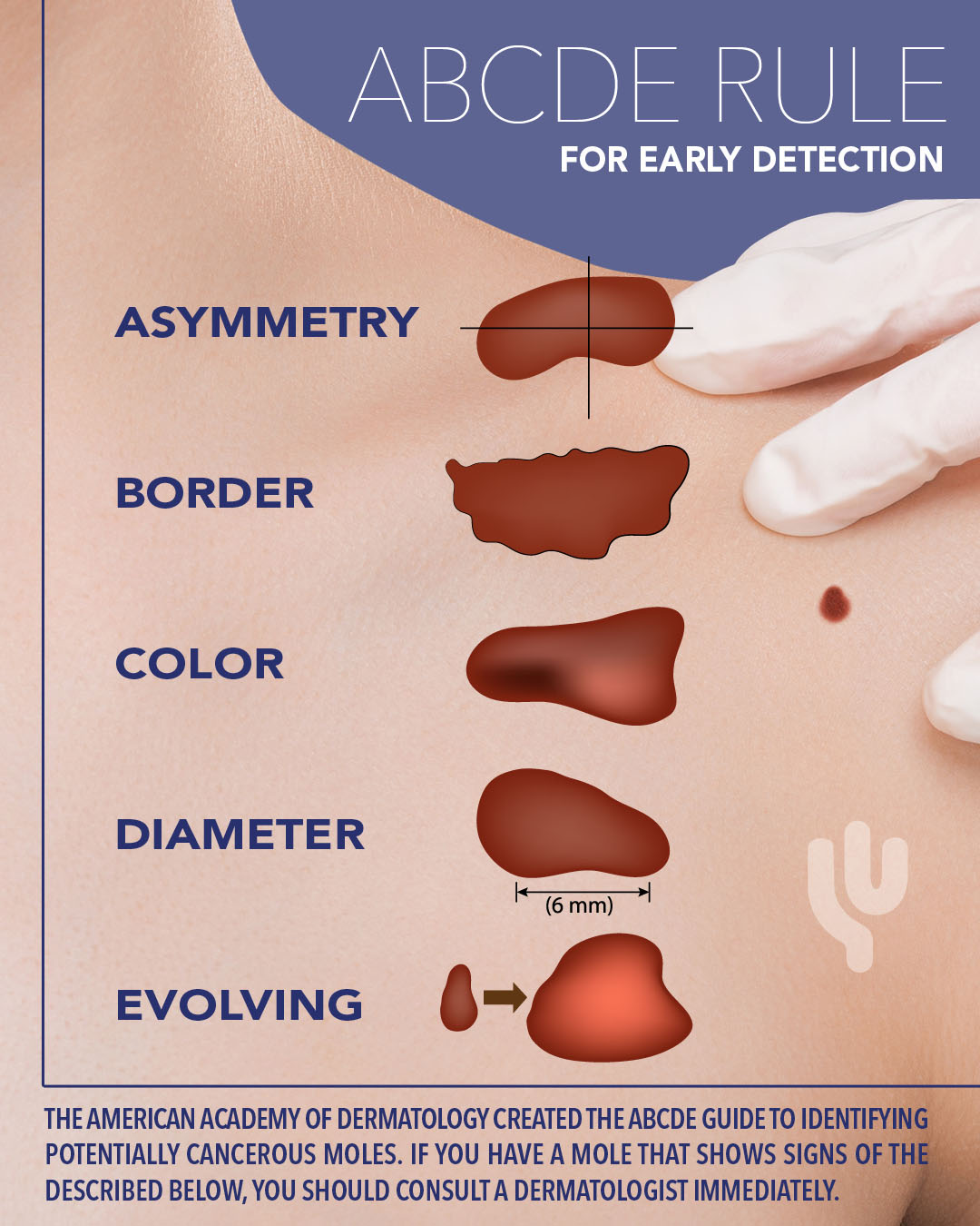 The ABCDEs of Melanoma