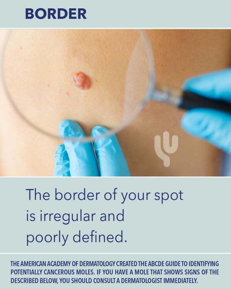 The ABCDEs of Melanoma | Saguaro Dermatology