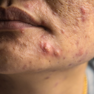Profile view of a male teenager's face with acne