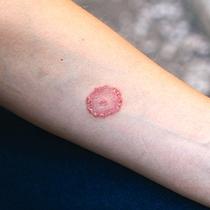 ringworm in humans treatment