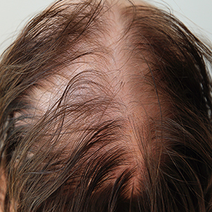 Profile view of a male teenager's face with acne