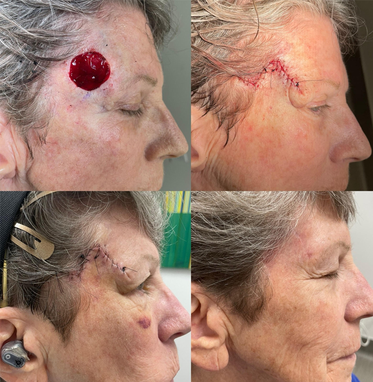 Mohs Surgery Before and After