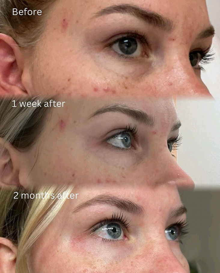Platelet Rich Plasma Treatments | Before and After | Second Example