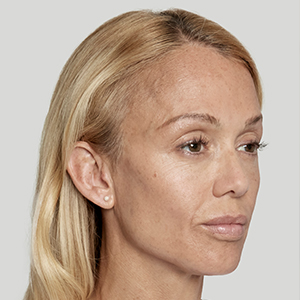 Profile view of a male teenager's face with acne